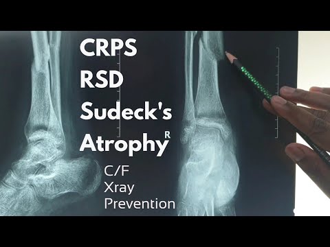 CRPS/RSD/Sudeck&rsquo;s Atrophy/Algodystrophy || C/F & Xray findings & prevention || Dr Abdullah Al Rafi