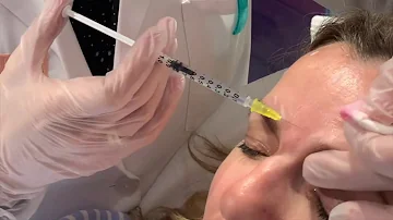 ¿Dónde no se debe inyectar Botox?