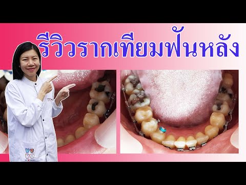 รีวิวรากเทียมฟันหลัง