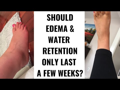 Edema / Water Retention / Swelling - Lasting Longer than a Year in Recovery