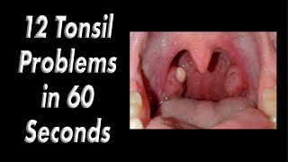 12 Tonsil Problems in 60 Seconds by Fauquier ENT 1,979 views 5 days ago 1 minute, 8 seconds