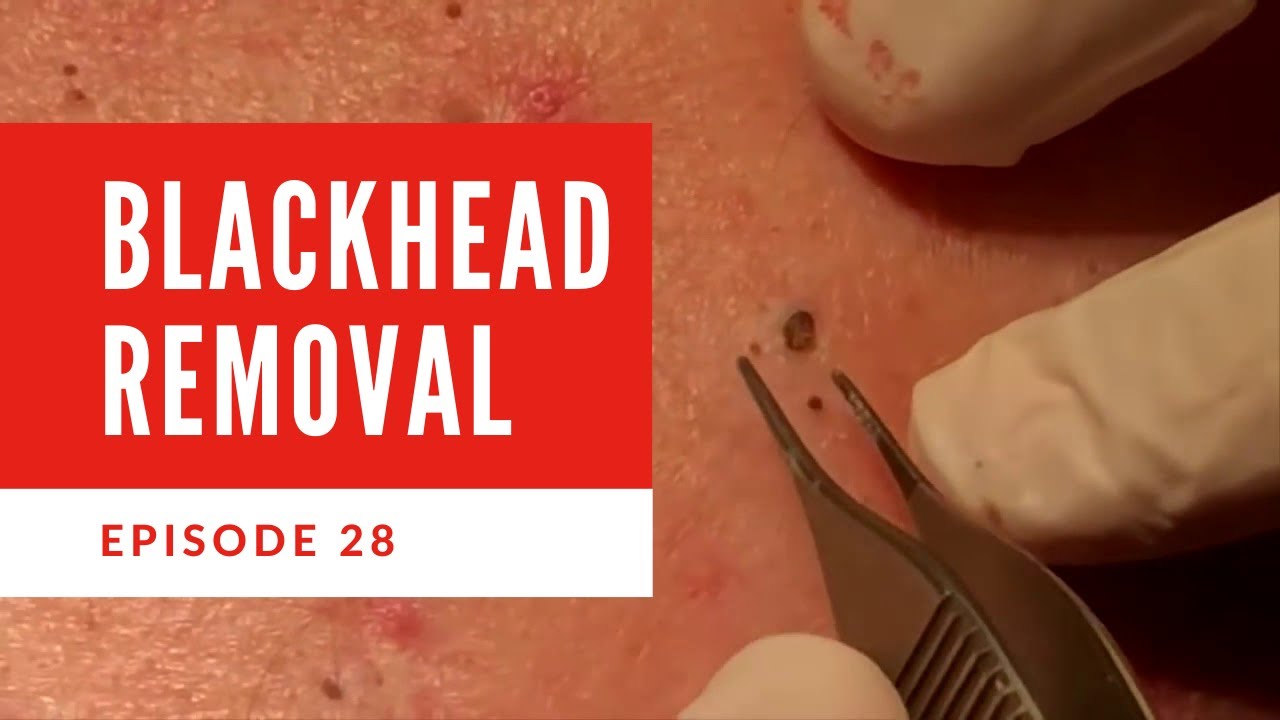 Blackhead Removal on back and excellent blackhead extraction EP28 YouTube