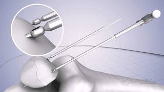 Double Medical Patella Pin Fixation System
