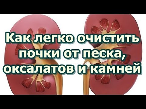 Видео: Оксалатни камъни в бъбреците (оксалатурия) - лечение, симптоми