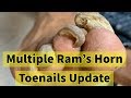 Multiple Ram's Horn Toenails Update: He Is Making Progress