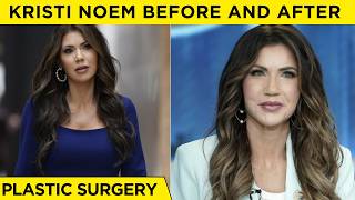Kristi Noem Before and After Plastic Surgery | Cosmetic Surgery Rumors Explained