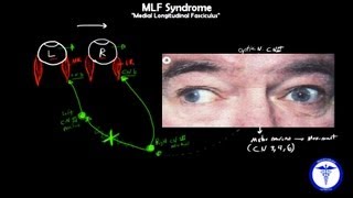 MLF syndrome - Internuclear Ophthalmoplegia, MADE EASY