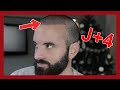 J+4 : Mes greffons pèlent ! | MA 2ÈME GREFFE DE CHEVEUX