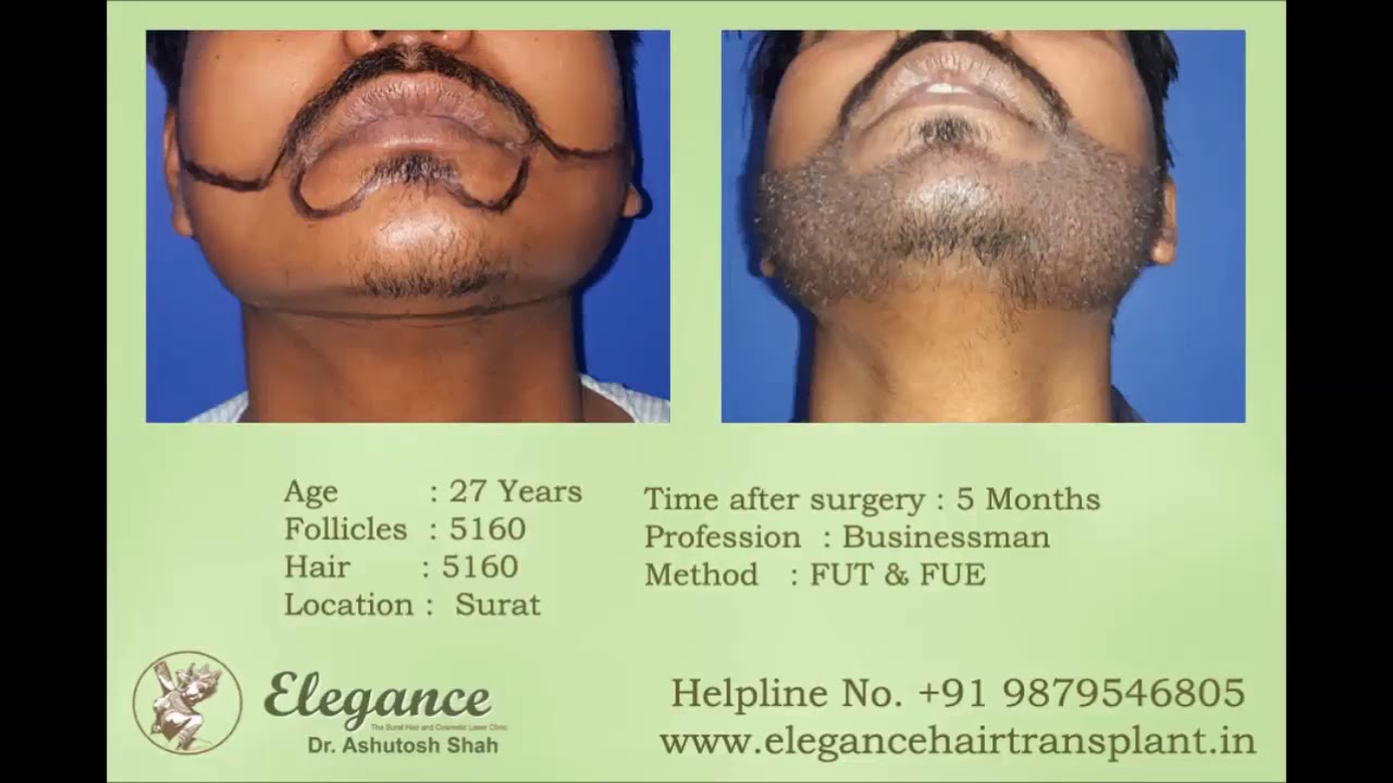 Beard Hair Transplant, Hair implant, facial hair Patient Testimonial