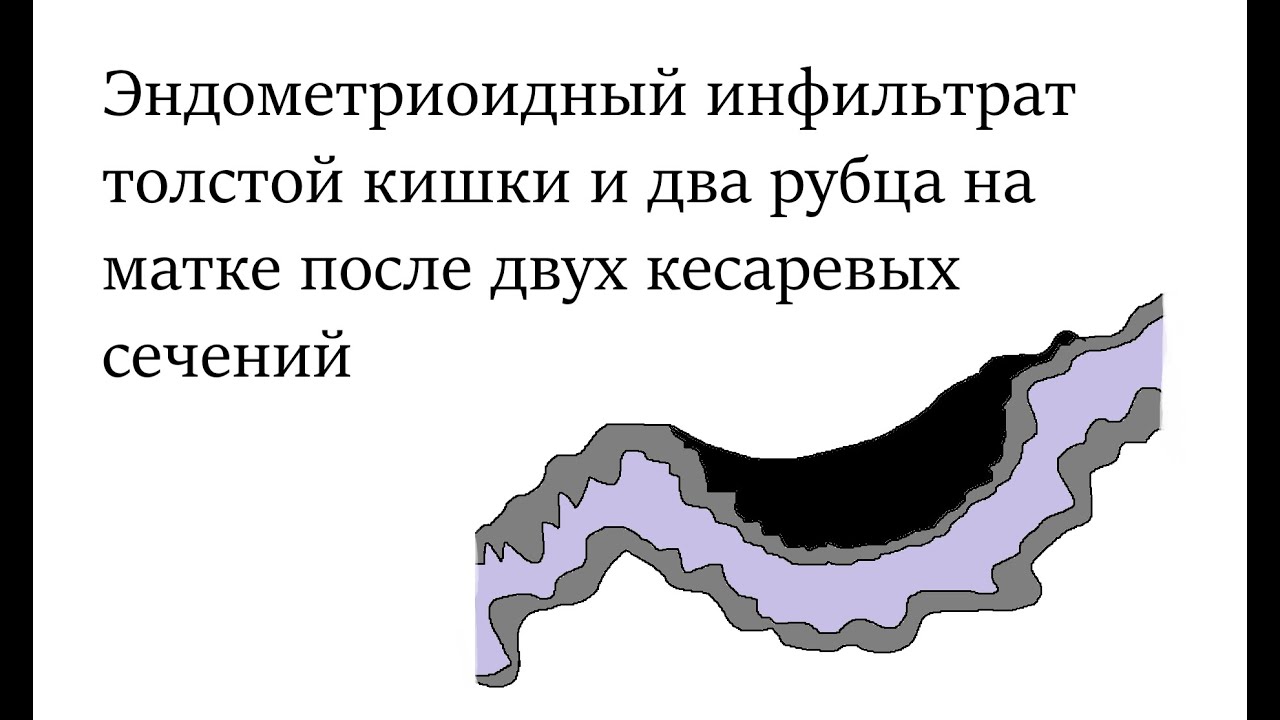 Матка после 2 кесарева. Ретроцервикальный эндометриоз на УЗИ. Эндометриоз рубца на матке. Инфильтрат в Малом тазу.