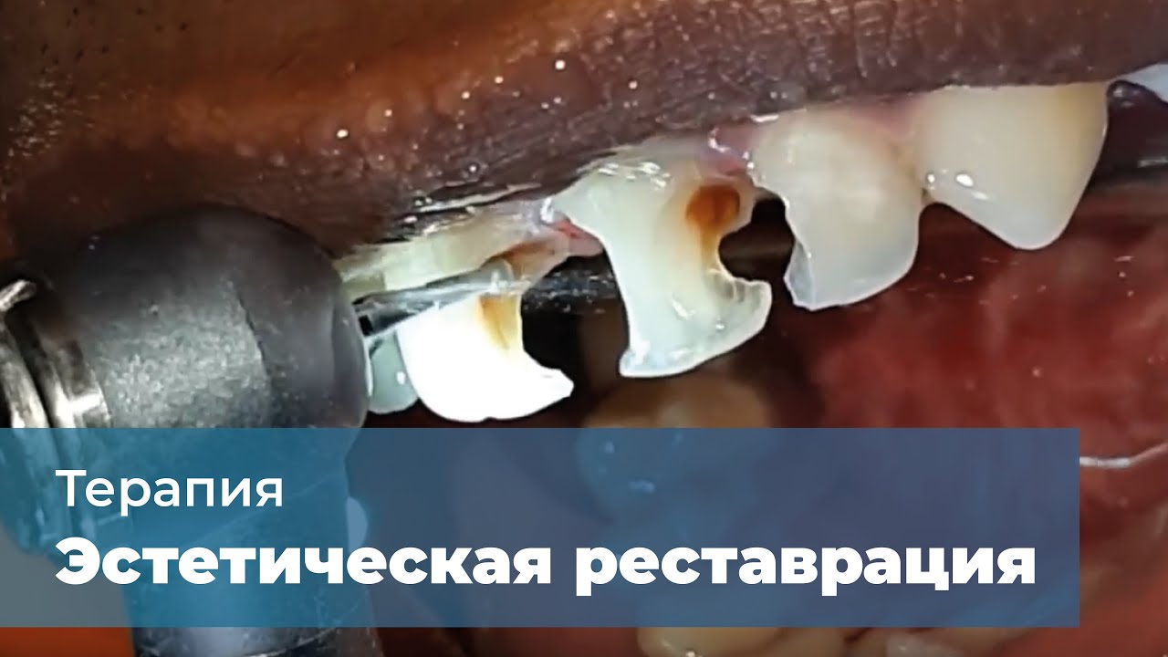 Эстетическая реставрация фронтальной группы зубов