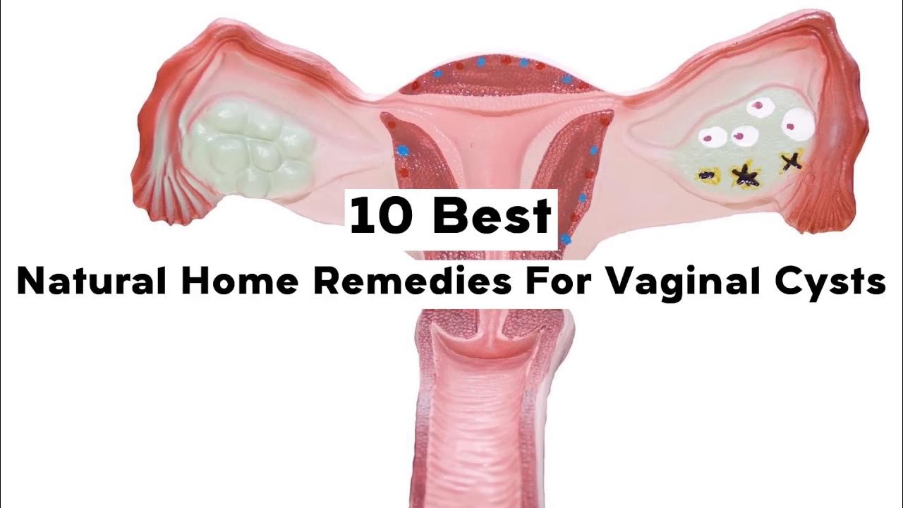 homemade remedy for vaginal cys