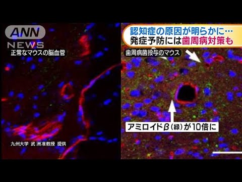 認知症の原因が明らかに　発症予防には歯周病対策を(2020年10月13日)