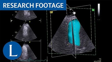 Contrast 3D echocardiography to quantify left ventricular volumes and ejection fraction