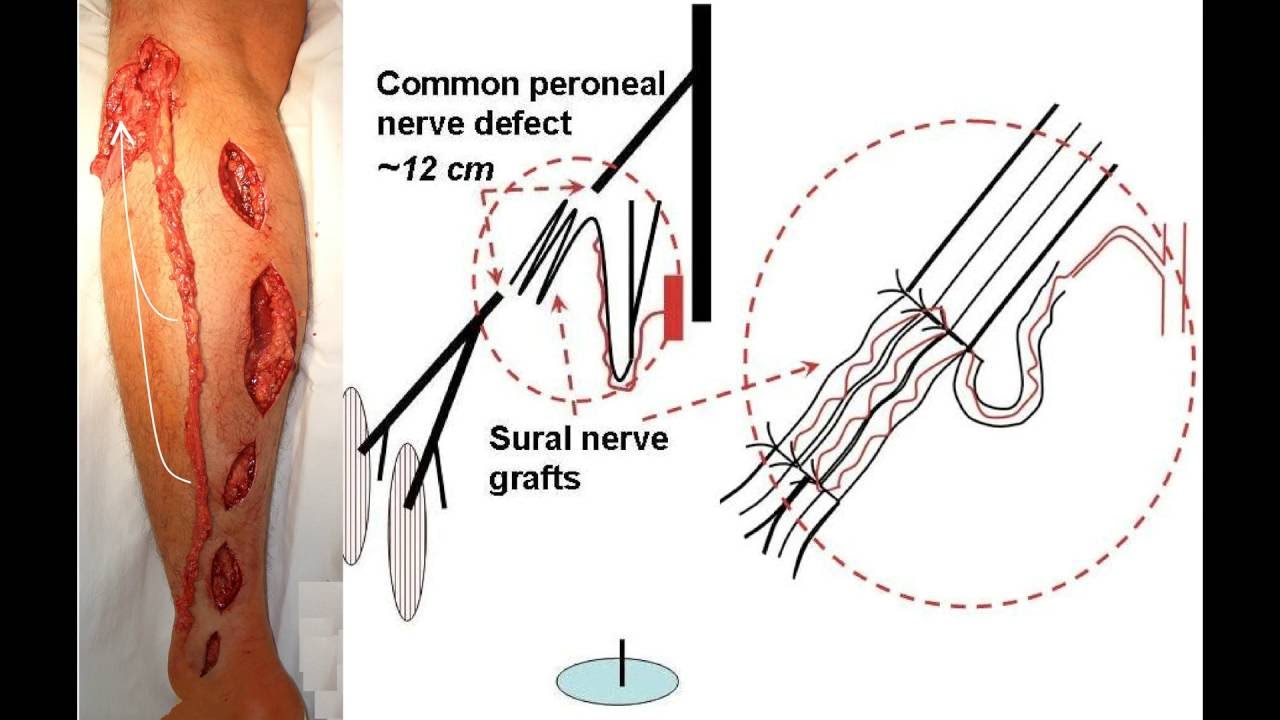 Peroneal Nerve Injury Treatment. Vascularized Sural Graft (A Foot Drop