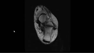 CASE 1044 MRI ANKLE OSTRIGONUM SYNDROME FHL TENOSYNOVITIS