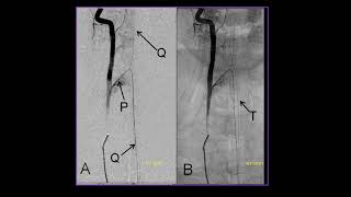 Imaging Spine vascular infarct,anatomy and malformations