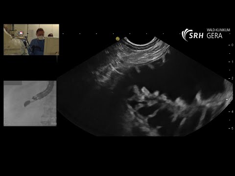 Syndrom der zuführenden Schlinge, Afferent-Loop-Syndrom, endoskopische Therapie