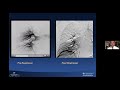 Monthly CV Forum: June 2021: Acute or Chronic Pulmonary Embolism