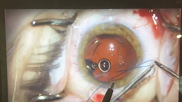 Technique Video: Double flange-capsular tension segment (Canabrava Technique) + CTR -Rami Shasha MD