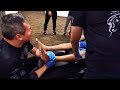 Throwback year 2019- CLM Tit Tar Adjustment for patients ankle injury due to motorbike accidents.