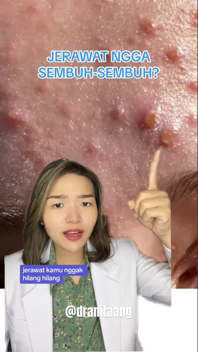 ALASAN JERAWAT NGGA SEMBUH-SEMBUH‼️ #skincaretips #jerawat #aestheticdoctor #makananmanis