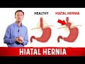 Hiatal Hernia – Quick Fix Treatment by Dr.Berg