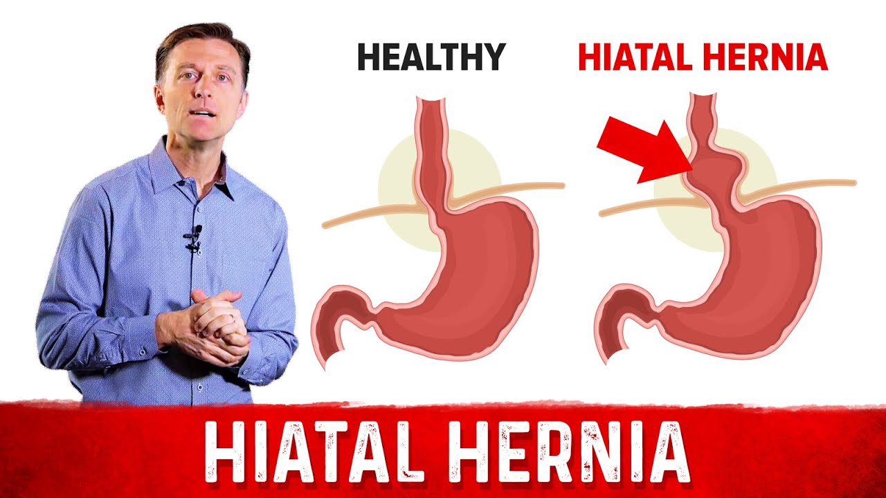 Quick Fix For Hiatal Hernia Dr Berg Youtube