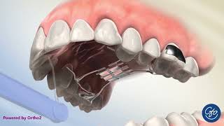 How an Orthodontic Expander Works: Animated Guide to Rapid Palatal Expander (RPE) & Hyrax!