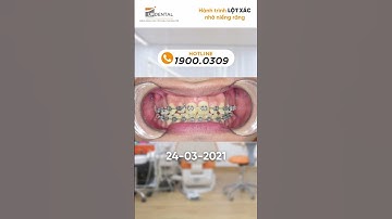 Hành trình lột xác nhờ niềng răng của khách hàng Minh Kiệt