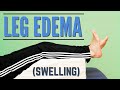 Top 7 Exercises for Leg Edema or Swelling (Program or Protocol for Edema)