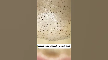 ازالة الرؤوس السوداء 