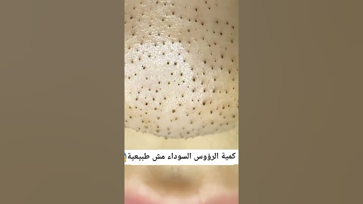 ازالة الرؤوس السوداء