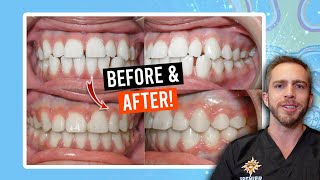 Braces Spacing Treatment! [BEFORE &amp; AFTER]