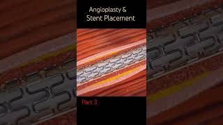 Coronary Artery Disease Angioplasty & Stent Placement