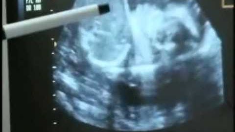 Smoking Ultrasound