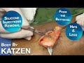 Butt Shots - Removal of Silicone Injections from the Buttocks Hips and Tibia