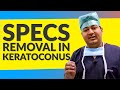 Specs Removal in Keratoconus | केरैटोकोनस रोगी चश्मा हटायें-स्पेशल कांटैक्ट लेंस | Hard Contact Lens