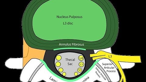 How to Read Your MRI with Onis 2.5 – part I (Advanced Lumbar Spine)