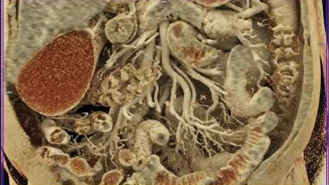 Mesenteric Arcade with Cinematic Rendering