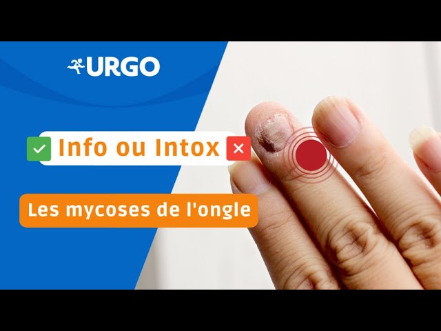 Mode d'emploi : Comment appliquer URGO Filmogel® Mycose EXPRESS ?​ 