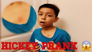 My brother does a hickey prank on my sister😱(GONE WRONG)