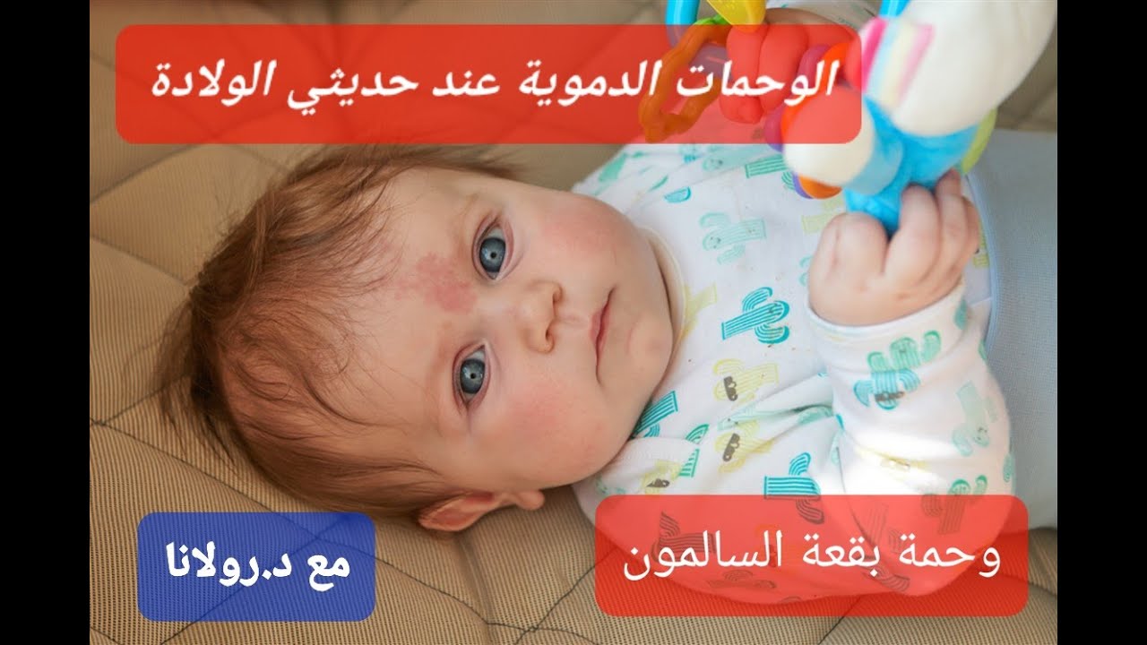 الوحمات الحمراء عند الأطفال حديثي الولادة (وحمة بقعة السالمون ،قبلة الملائكة،عضة اللقلق) مع د.رولانا