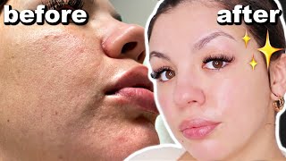 How To Get Rid Of DRY And TEXTURED SKIN | Skincare Routine