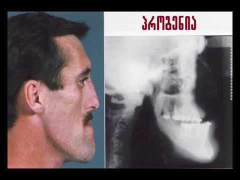 დავით ბახტურიძე ორთოდონტიული მომზადება და ორთოგნათიული ქირურგია