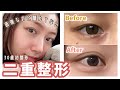 【二重整形】当日メイク可能腫れない二重術！30歳でアイプチ卒業