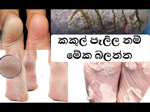 how-to-heal-cracked-heels/feet-home-remedy/removal-කකුල්-පැලිල-නම්-මේක-බලන්න-sinhala