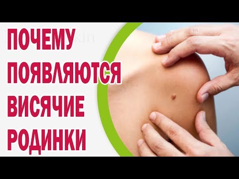 Почему на теле появляются висячие родинки