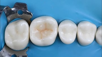 Anatomy for upper molar DR : Ibrahim Abdelmunim
