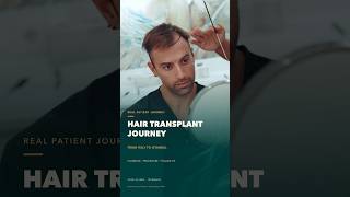 Hair Transplant Journey from Italy | Mr. Dalla Pozza